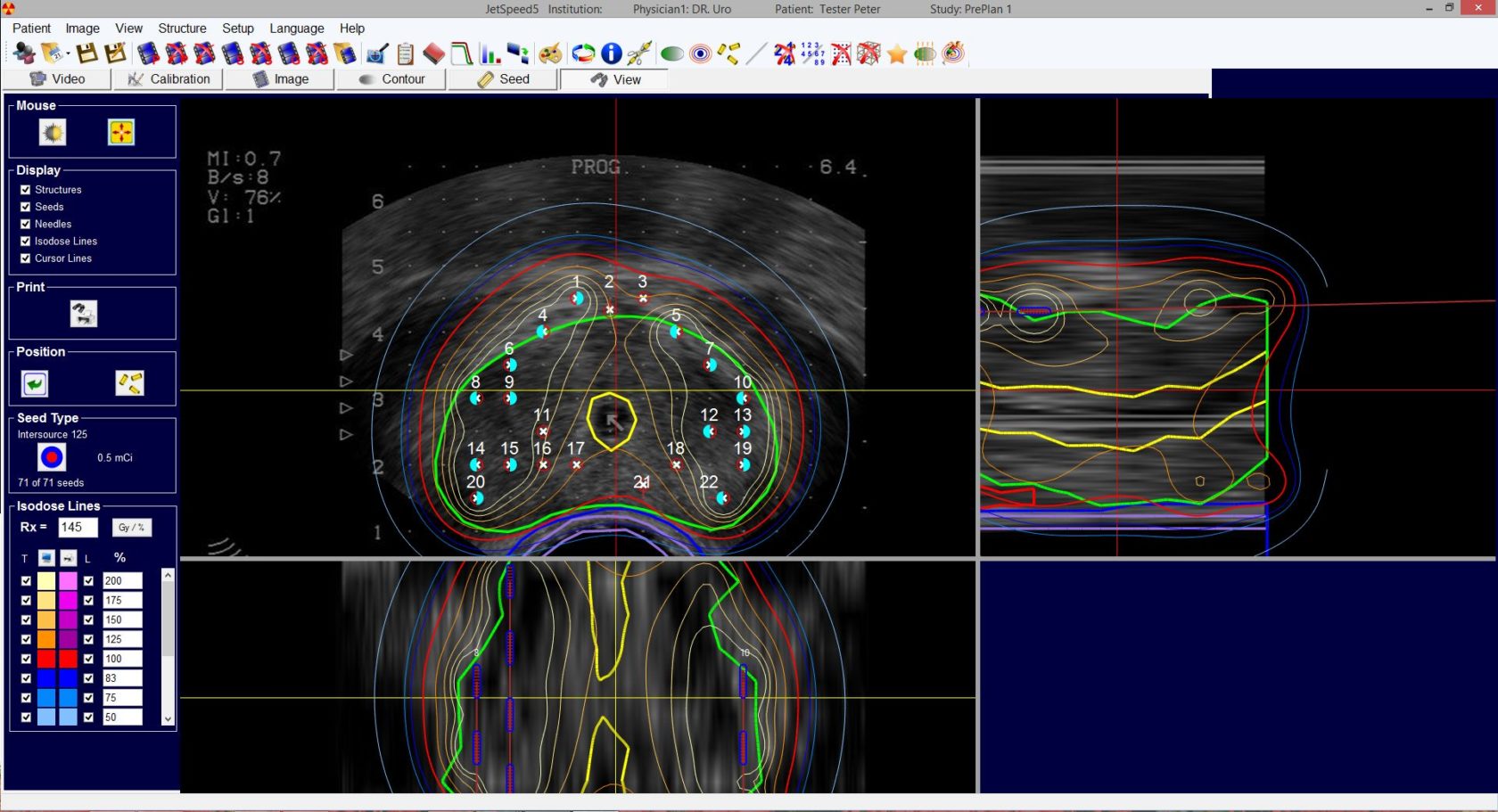 LDR Brachytherapy software JetSpeed5 für CT / MR / Ultraschall-Nachplanungsprozesse