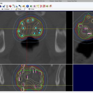 LDR Brachytherapy software JetSpeed5 control program