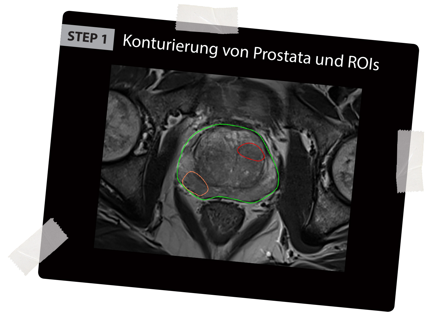 BioJet MRI-Fusionbiopsies first step contouring of the prostate and the suspicious areas in the MRI