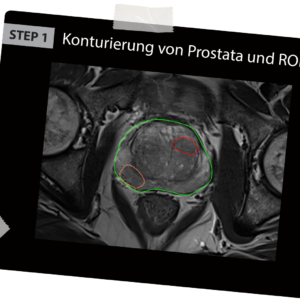 BioJet MRI-Fusionbiopsies first step contouring of the prostate and the suspicious areas in the MRI