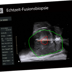 BioJet MRI-Fusionbiopsies second step fusion of MRI data in real time with ultrasound image