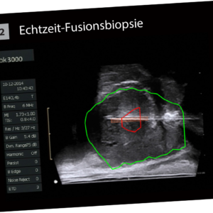 BioJet MRT Fusion zweiter Schritt Fusion der MRT Daten in Echtzeit mit dem Ultraschallbild