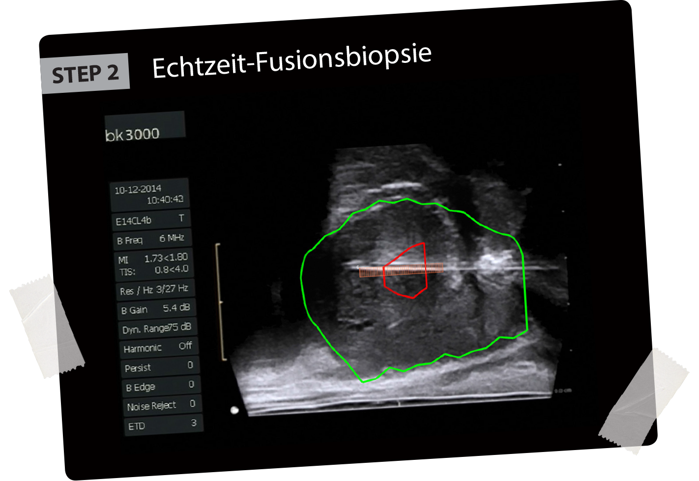 BioJet MRI-Fusionbiopsies second step fusion of MRI data in real time with ultrasound image
