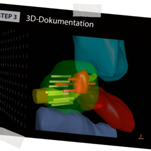 BioJet MRT Fusion Dritter Schritt: Präzise Entnahme der Biopsien inklusive 3D Dokumentation in Echtzeit