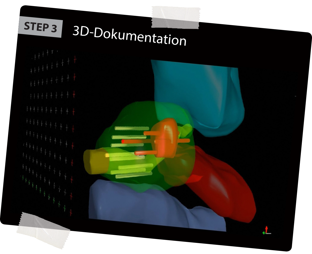 BioJet MRT Fusion Dritter Schritt: Präzise Entnahme der Biopsien inklusive 3D Dokumentation in Echtzeit
